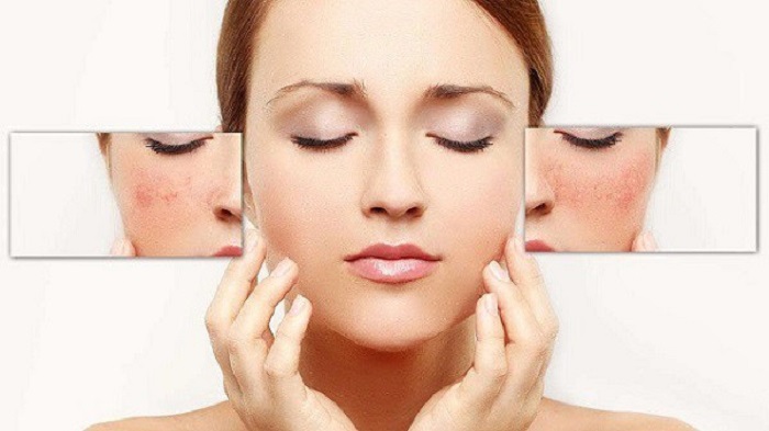 Cách trị da thâm nám