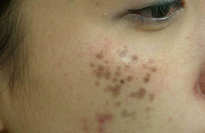 Cách trị nám chân đinh tại nhà Cách trị nám chân đinh tại nhà