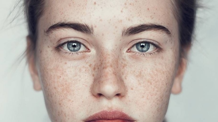 Cây thuốc trị nám nặng