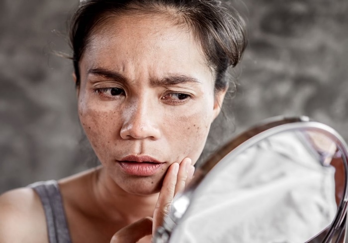 Chữa nám da bằng thuốc dân gian Chữa nám da bằng thuốc dân gian