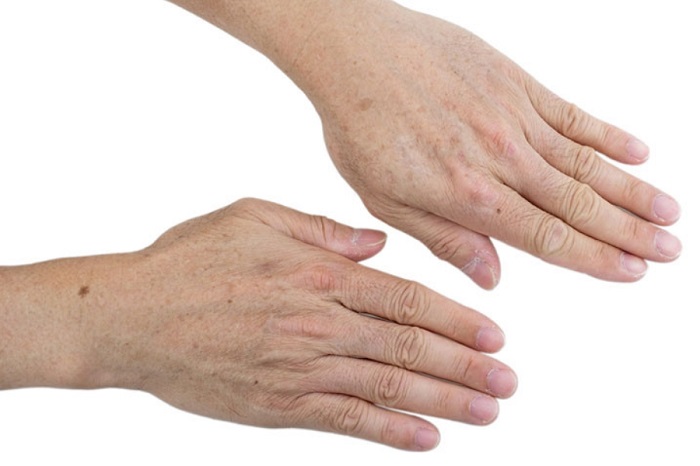 Da tay bị nám Da tay bị nám