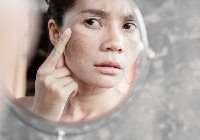 Kem dưỡng da trị nám ốc sên Kem dưỡng da trị nám ốc sên