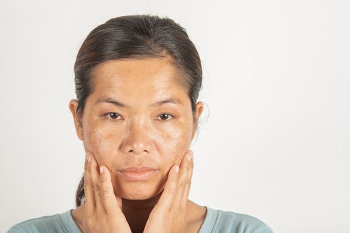 Kem nghệ có trị nám không Kem nghệ có trị nám không