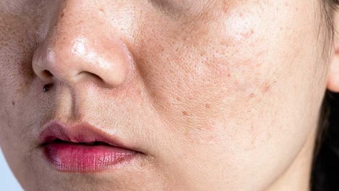 Kem thâm nám jp martic