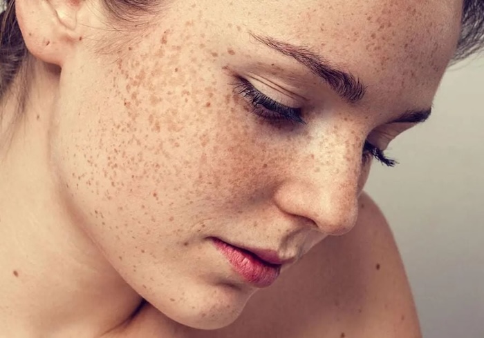 Kem trắng da trị nám loreal