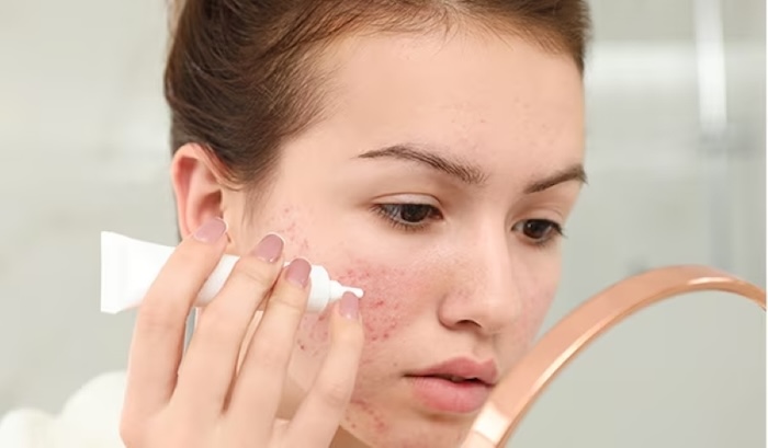 Kem trị mụn và nám Kem trị mụn và nám