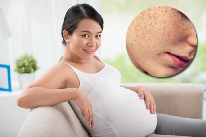 Kem trị nám cho bà bầu