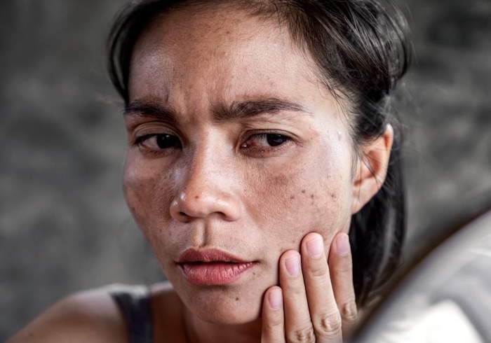 Kem trị nám giá bình dân