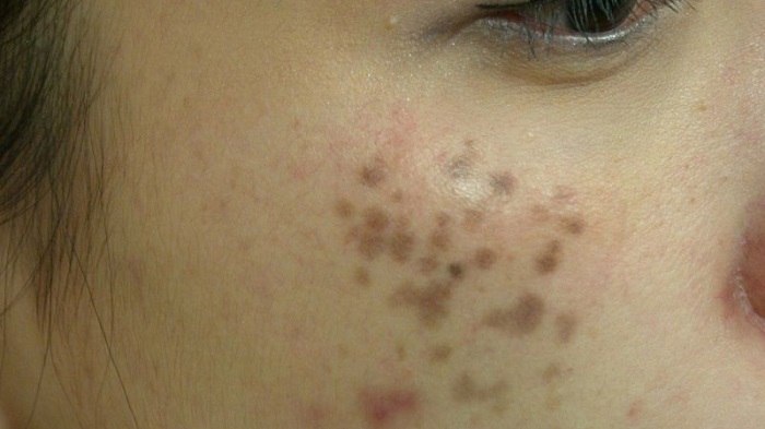 Nám chân đinh là gì