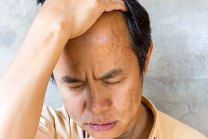 Nam giới bị nám da mặt