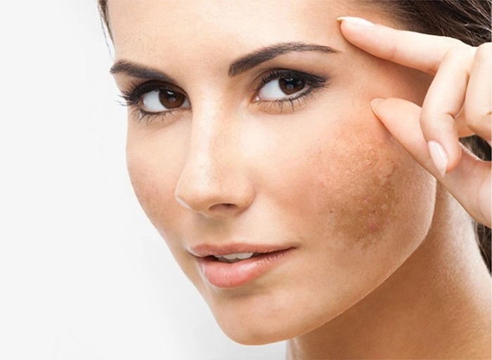 Nấu nước tía tô với gừng trị nám Nấu nước tía tô với gừng trị nám