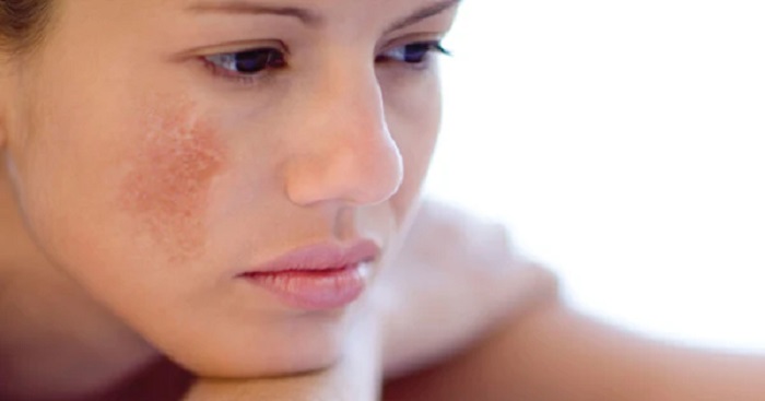 Sau sinh mặt bị nám