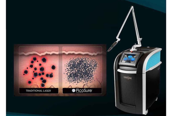 Trị nám bằng công nghệ picosure