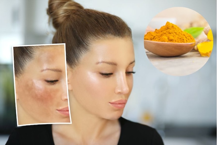 Trị nám bằng tinh bột nghệ và mật ong Trị nám bằng tinh bột nghệ và mật ong