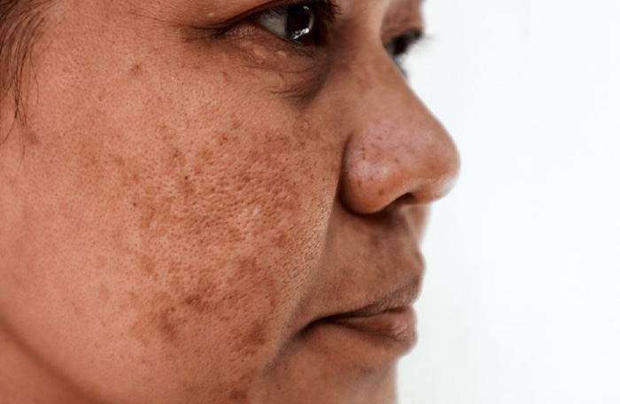 Trị nám chân sâu Trị nám chân sâu