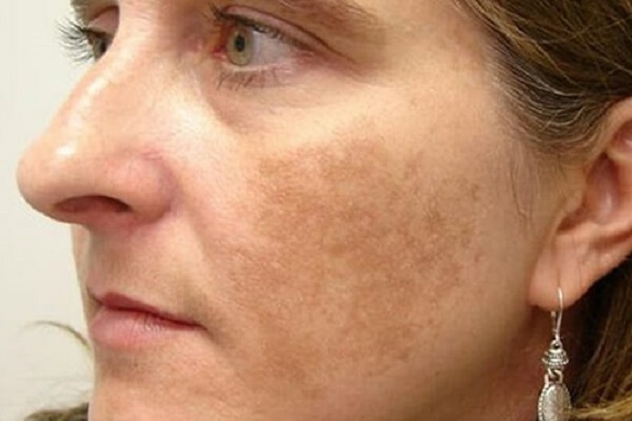 Viên uống trị nám của murad Viên uống trị nám của murad