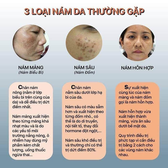 Các loại nám và nguyên nhân