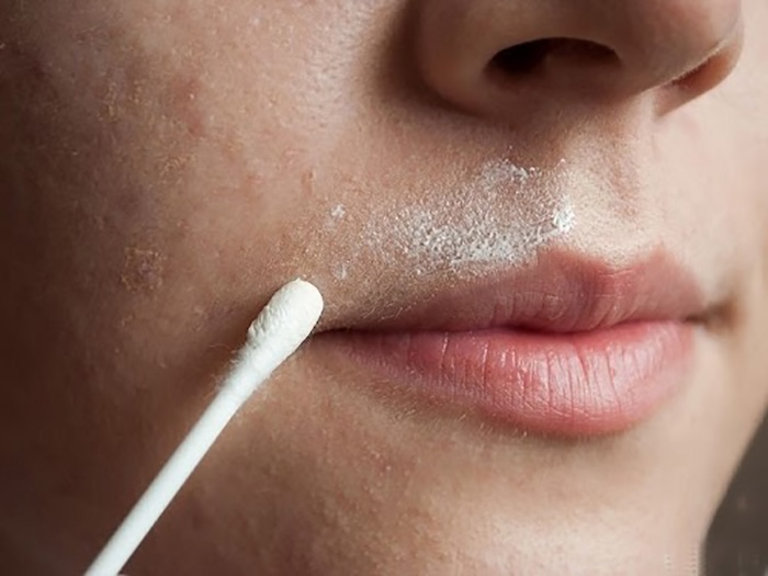 Cách trị nám vùng miệng