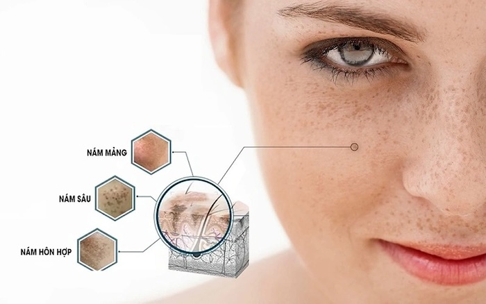 Chi phí điều trị nám da