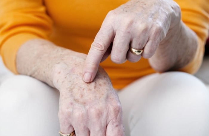 Da tay bị nám đồi mồi