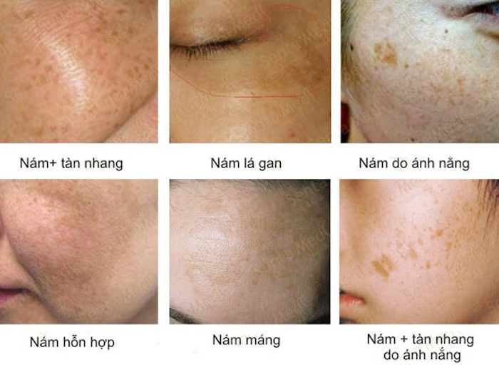 Hình ảnh các loại nám