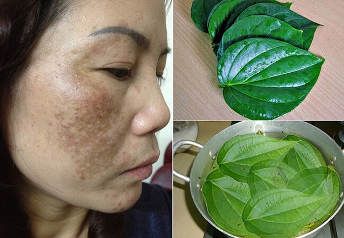 Kinh nghiệm trị nám bằng la trầu không