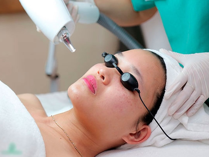 Máy laser bắn nám