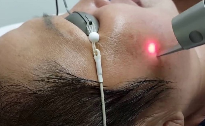 Máy laser trị nám tốt nhất hiện nay Máy laser trị nám tốt nhất hiện nay