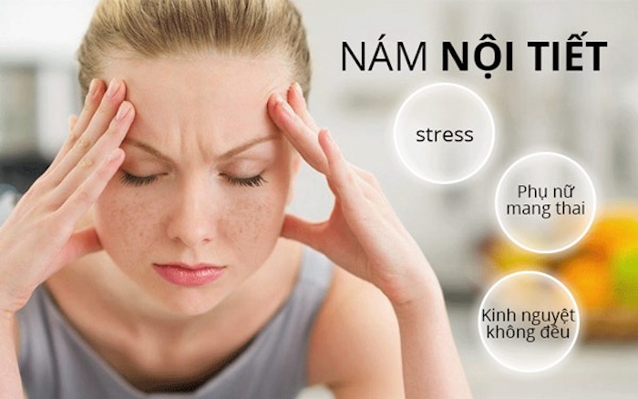 Nám nội tiết là gì