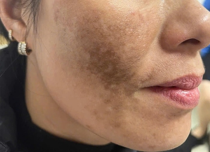 Serum giảm thâm nám