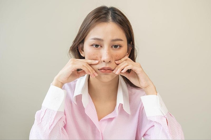 Serum trị nám tốt nhất của mỹ