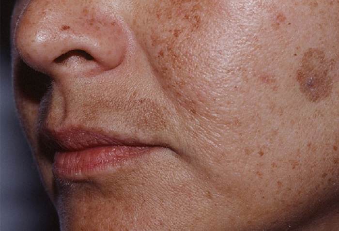 Tế bào gốc trị nám honesi