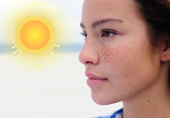 Trị nám nắng da mặt