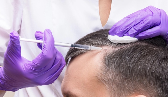 Bảng giá cấy tóc nam