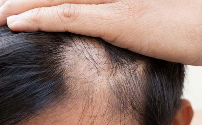 Bệnh rụng tóc hói đầu