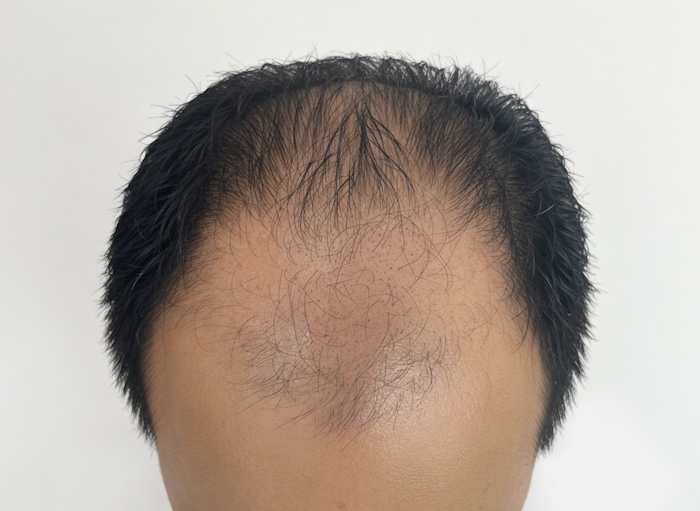 Bị hói chữ m