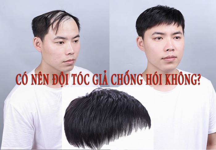 Bị hói có nên đội tóc giả không