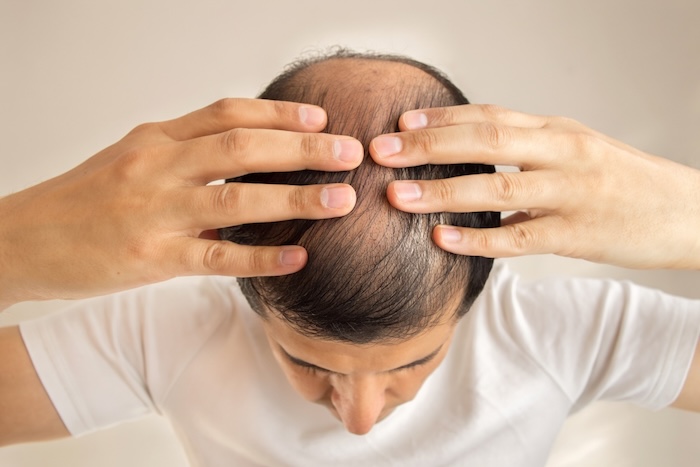 Bị hói đầu