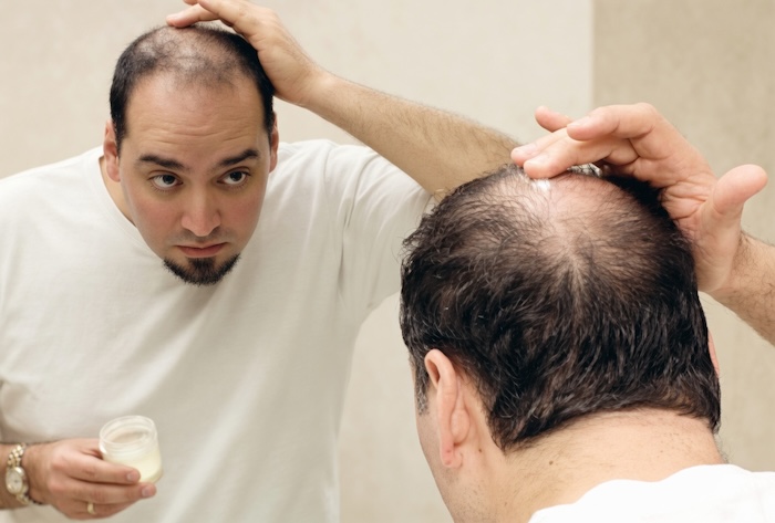 Bị hói đầu là bệnh gì Bị hói đầu là bệnh gì