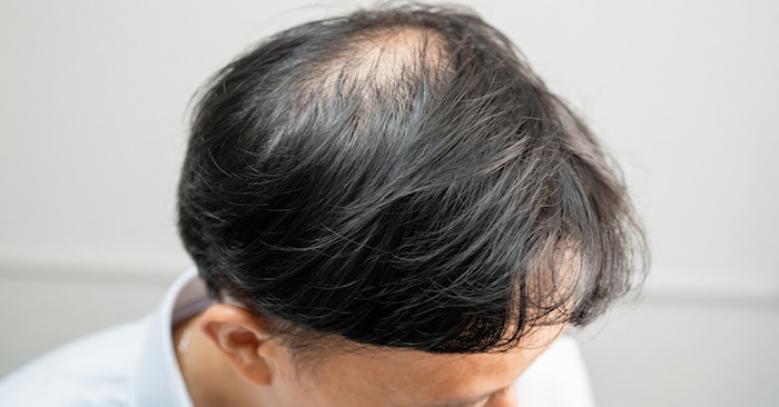 Bị hói đầu sớm Bị hói đầu sớm