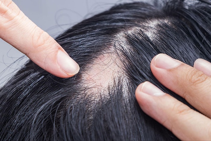 Bị hói ở đỉnh đầu
