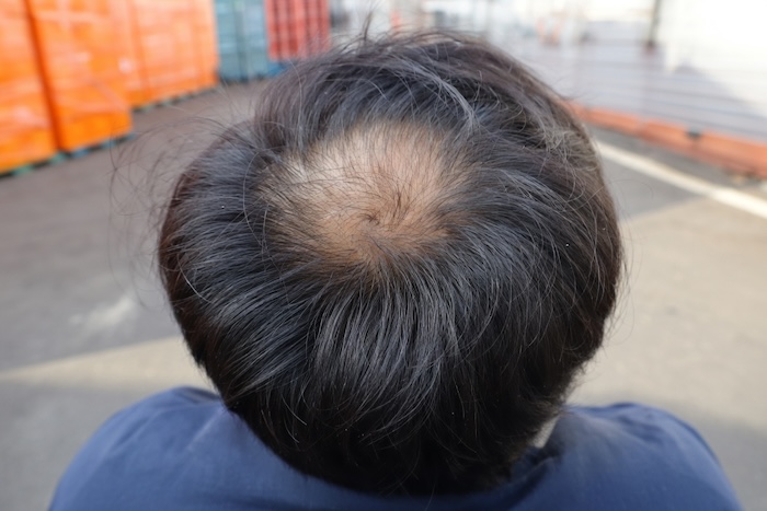 Bị hói ở đỉnh đầu nam