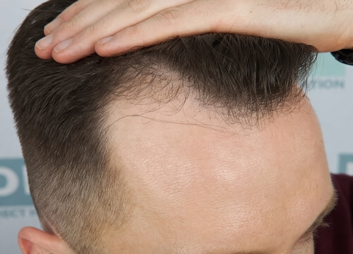 Bị hói ở trán