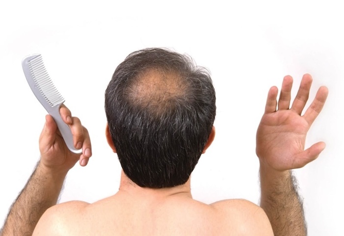 Bị hói phải làm sao