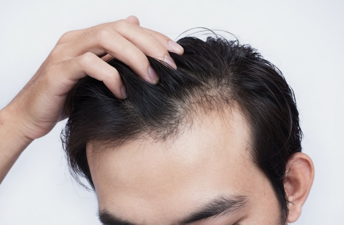 Bị hói tóc