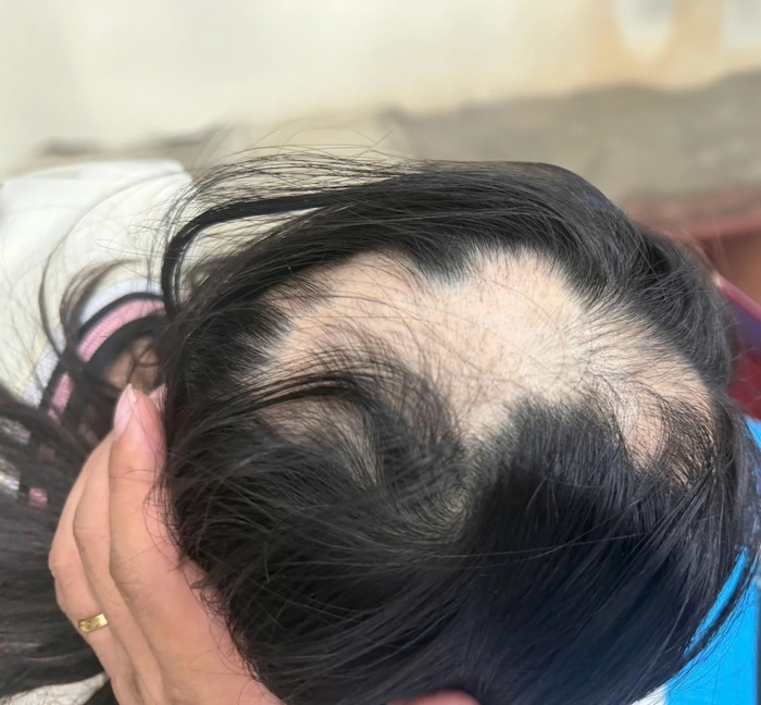 Bị rụng tóc hói đầu