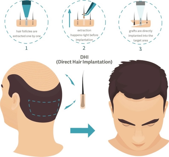 Bút cấy tóc dhi