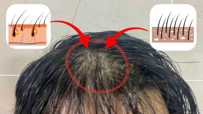 Các dấu hiệu của hói đầu Các dấu hiệu của hói đầu