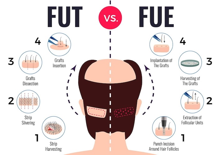 Các phương pháp cấy tóc tự thân