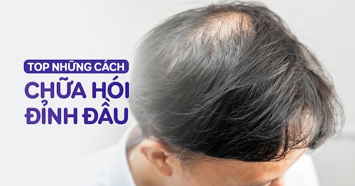Cách che hói đỉnh đầu
